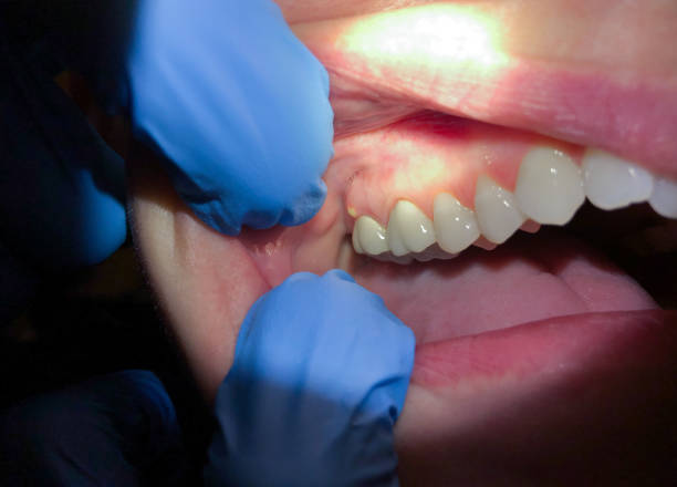 Best Broken or Chipped Tooth Repair in Chattanooga, TN