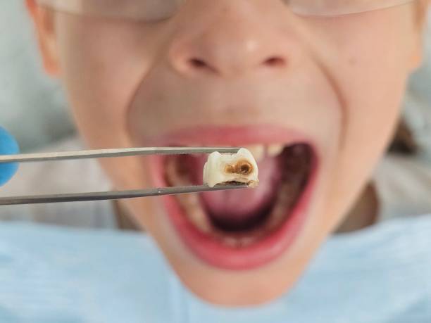 Best Emergency Care for Gum Disease in Chattanooga, TN